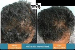 prpforhairloss1