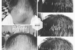prpforhairloss3